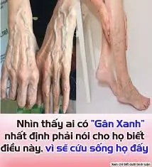 Nhìn thấy ai có “gȃn xanh” nhất định phải nói cho họ biḗt điều nàу, vì sẽ cứu sṓng họ đấy