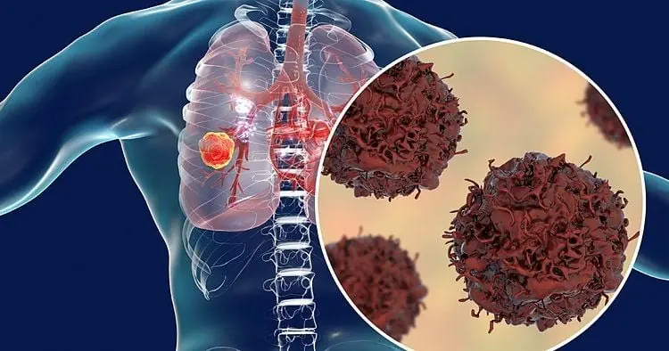 6 cơn đau xuất hiện báo hiệu tế bào ung thư đã phát triển đến giai đoạn cuối